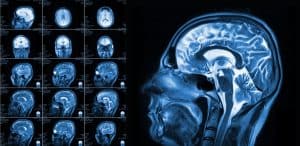 Seniors Are Increasingly Suffering from Traumatic Brain Injuries and Concussions 