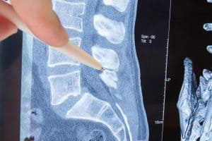 The Dangers of Undiagnosed Spinal Stenosis