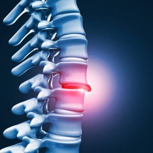 Can I Suffer a Herniated Disc in a Car Accident?