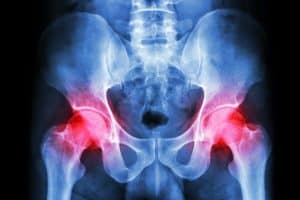 How Hip and Pelvic Injuries From Car Accidents Can Affect Your Life