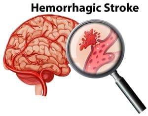 What Are the Causes of a Hemorrhagic Stroke?