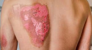How Severe Burn Injuries Affect Your Organs